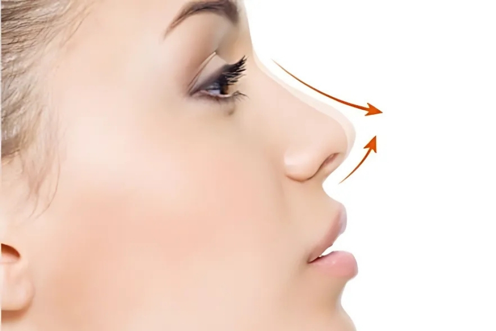 Rhinoplasty