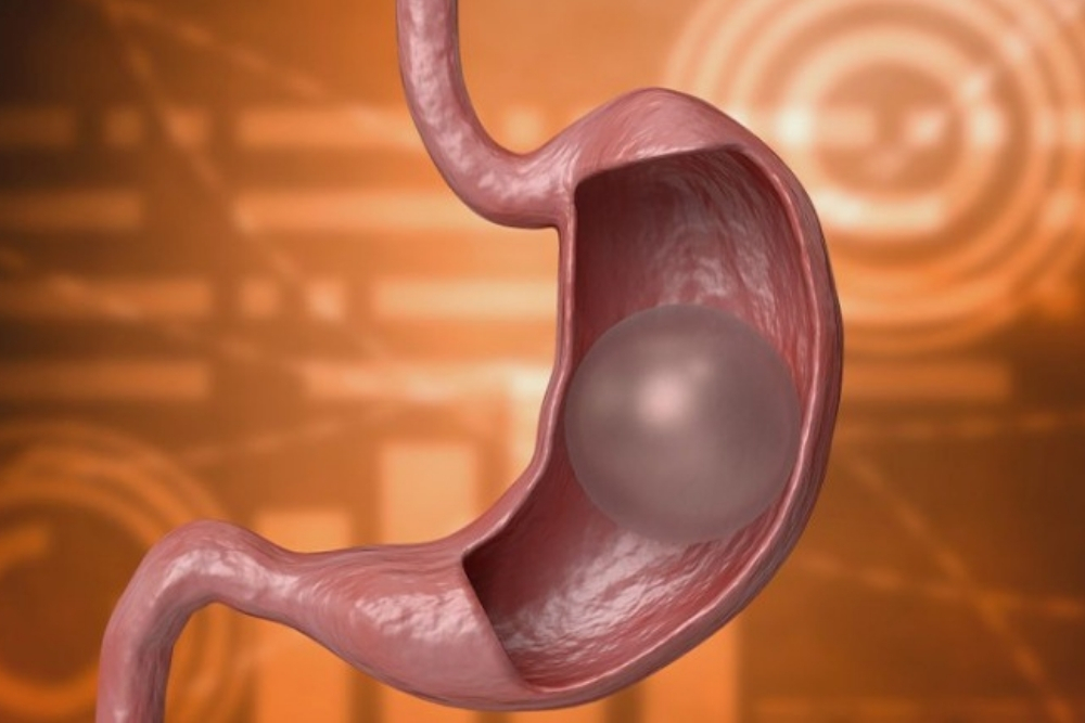 Gastric Balloon