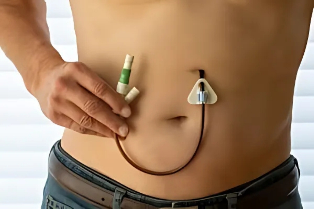 Tube Stomach